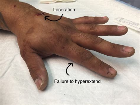 dropped hammer test medial|Extensor Tendon Injuries .